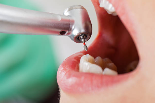 Best Dental Abscess Treatment in Wye, MT